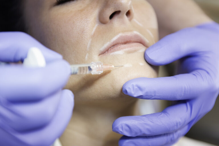 Älteste ästhetische Methode bringt sehr gute Ergebnisse – Revival des Chemical Peeling