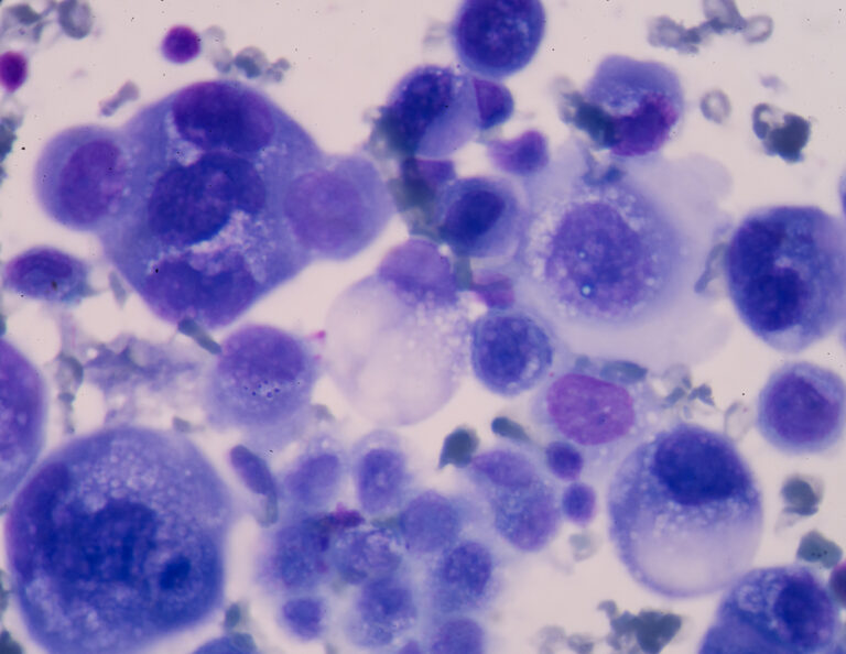 BRCA-mutiertes fortgeschrittenes Ovarialkarzinom – PARP-Inhibitor zeigt Langzeitnutzen hinsichtlich des PFS