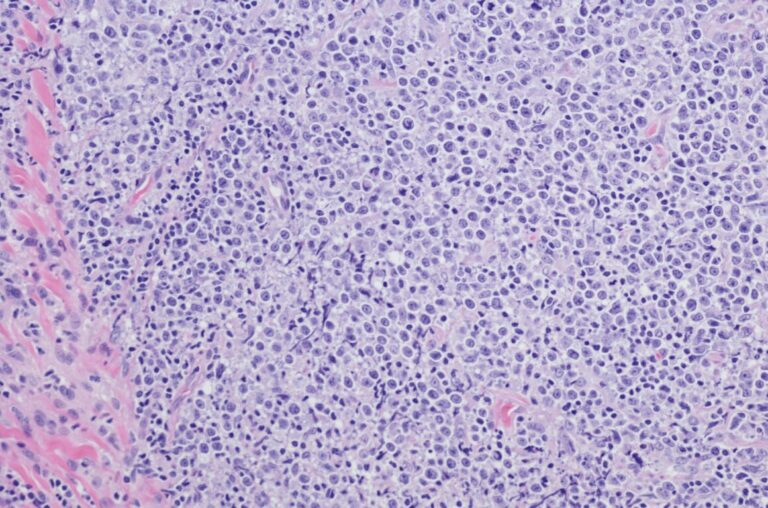 Kutanes Lymphom – das Chamäleon in der Dermatologie