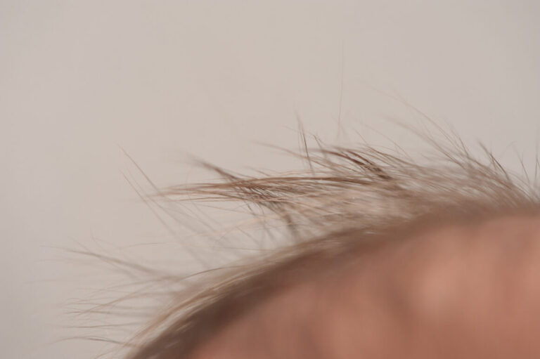 Keratosis follicularis spinulosa decalvans